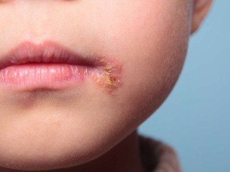 Cuando el Herpes es reincidente 